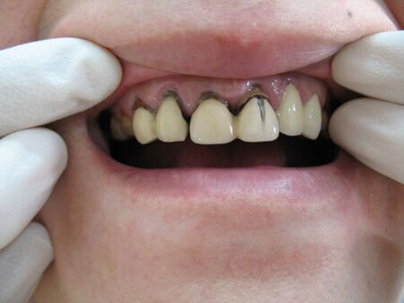 主页 牙齿修复 烤瓷牙    非贵金属烤瓷牙是由镍铬合金制成的金属内冠